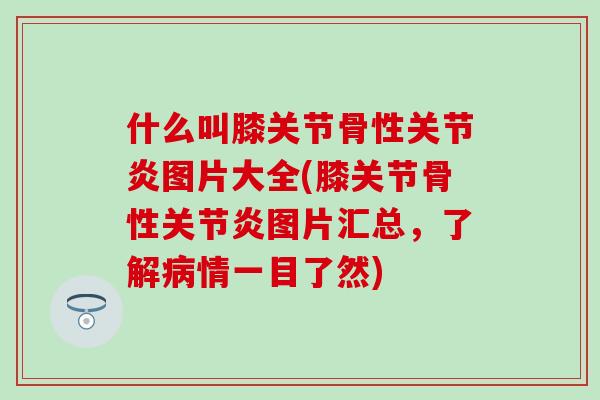 什么叫膝关节骨性关节炎图片大全(膝关节骨性关节炎图片汇总，了解病情一目了然)