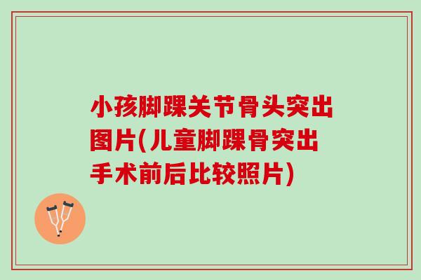 小孩脚踝关节骨头突出图片(儿童脚踝骨突出手术前后比较照片)
