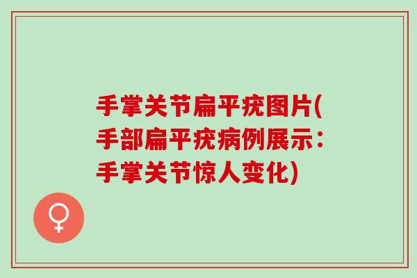 手掌关节扁平疣图片(手部扁平疣病例展示：手掌关节惊人变化)
