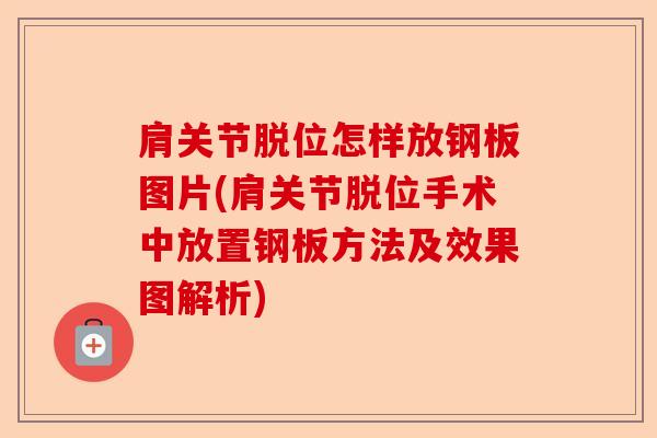 肩关节脱位怎样放钢板图片(肩关节脱位手术中放置钢板方法及效果图解析)