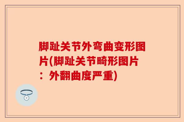 脚趾关节外弯曲变形图片(脚趾关节畸形图片:外翻曲度严重) 脚趾关节外弯曲变形图片(脚趾关节畸形图片:外翻曲度严重)